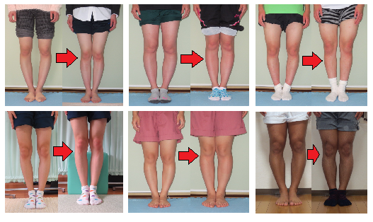 ｏ脚矯正 施術内容 みどり整体院 埼玉県蓮田市