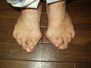 外反母趾 足の障害・みどり整体院